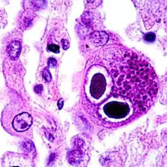 Cytomegalovirus (CMV) DNA PCR Qualitative